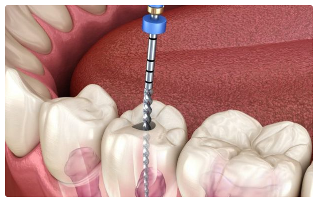 Is crown necessary to be done after a RCT treatment ?