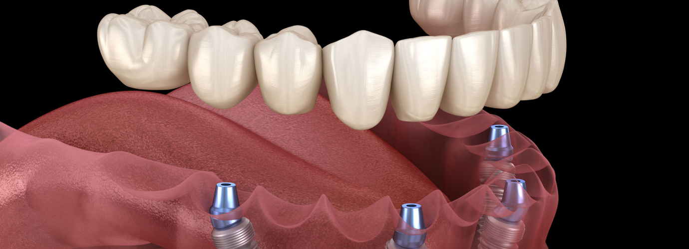 Care for Your Dental Implants